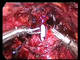Urethrovesical Anastomosis Bladder Neck Stitch by T.Frede